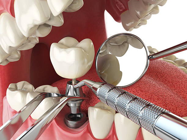 Best Emergency Treatment for Dental Infections or Abscesses in East Lansdowne, PA